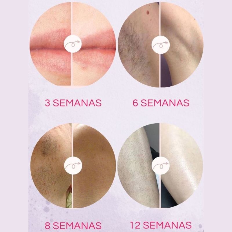 Removedor De Pelos Permanente Indolor + 2 BRINDES GRÁTIS • MZ IPL